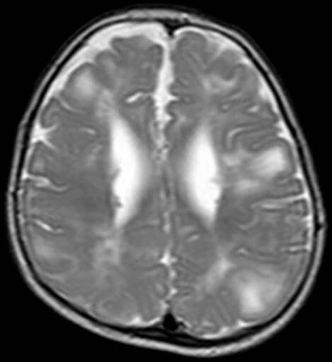 MRI mozku zobrazující subkortikální a subependymální hamartomy u pacienta s tuberózní sklerózou; T2-vážení, axiální řez mozkem.