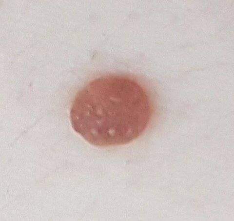 Papillomatous Nevus (ICD-10: D22) - Online consultation AI dermatologist