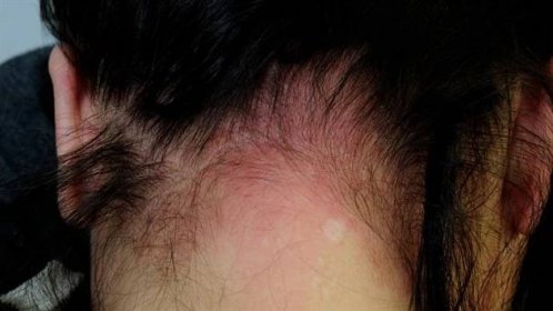 Zčervenání a zanícená kůže (kontaktní dermatitida) na šíji u pacientky v důsledku alergické reakce na barvu na vlasy.