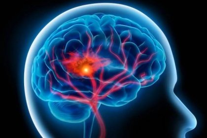 Cévní mozková příhoda - Kardiologická ambulance