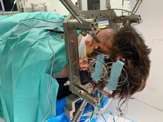 implantation d'electrode pour implatation 