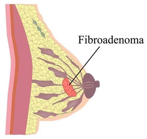 Fibroadenoma Treatment in Surat: Cost, Symptoms, Diagnosis, and Complications Meta Description: Learn about - Dr. Patki