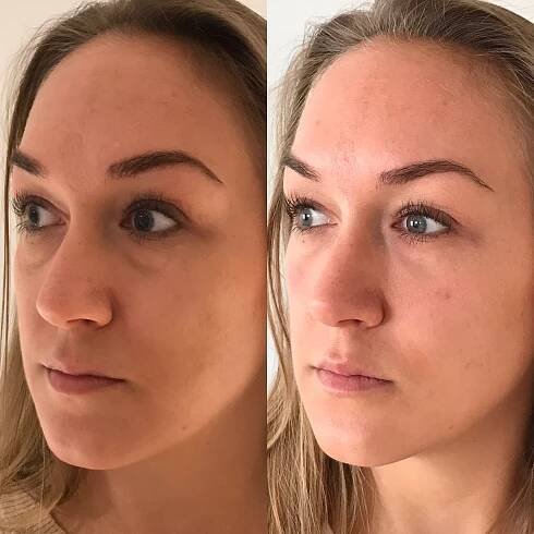 Restylane filler i Århus