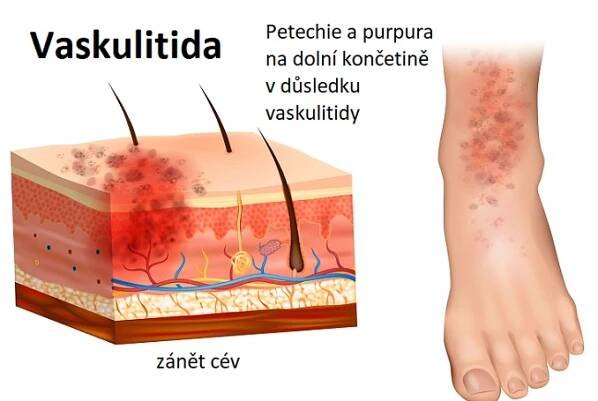 Vaskulitida - záněty cév - příznaky, příčiny a léčba