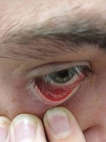 Pupínek oční víčko - Léčba očních zánětů - Diskuze