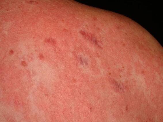 Urticaria chronic spontaneous