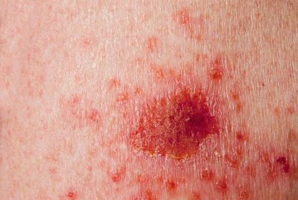 Příznaky rakoviny kůže - jak je rozpoznat a co dělat | Návod a rady
