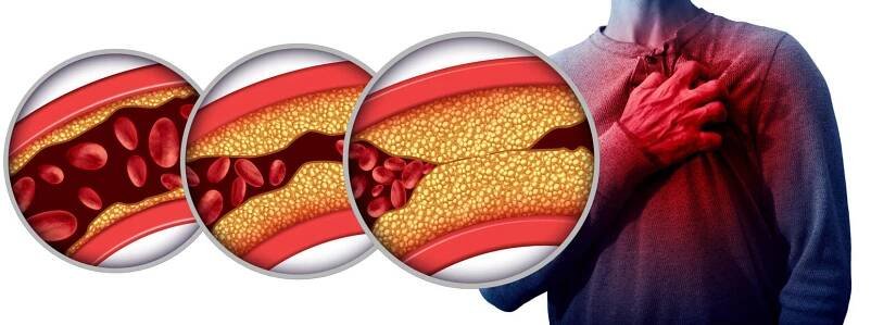 Proč je cholesterol špatný?