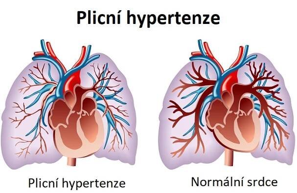 Plicní hypertenze - co to je - příznaky, příčiny a léčba