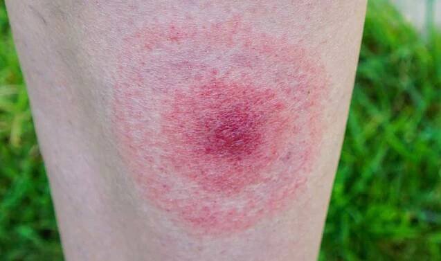 zákeřná Borrelia, Lymská borelióza