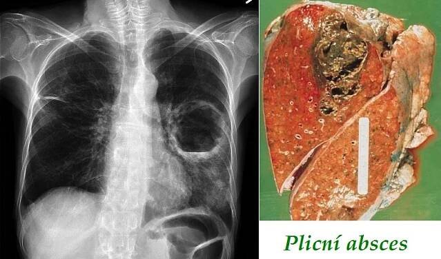 Plicní absces - příznaky, projevy, symptomy