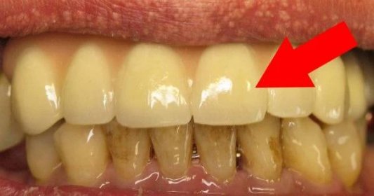 5 tipů, jak doma odstranit zubní kámen a mít krásné bílé zuby!