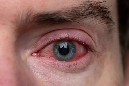Když očí svědí a pálí: Jak si na jaře poradit se sezonními alergiemi