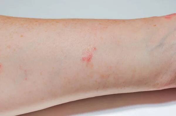 Alergická kožní vyrážka na vnitřním povrchu předloktí. Psoriáza, atopická dermatitida, ekzém. Kožní projevy. Kožní problémy — Stock obrázek