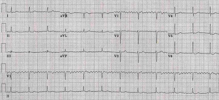 ECG digoxin toxicity, coarse regularised atrial fibrillation, Complete (3rd degree) heart block