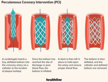 Illustration of percutaneous coronary intervention for coronary artery disease