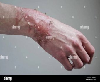 Close-up of a woman's hand with a burst blister from a boiled water burn, broken skin, 1st or 2nd degree burn. Painful wound. Thermal burn. Skin peels Stock Photo