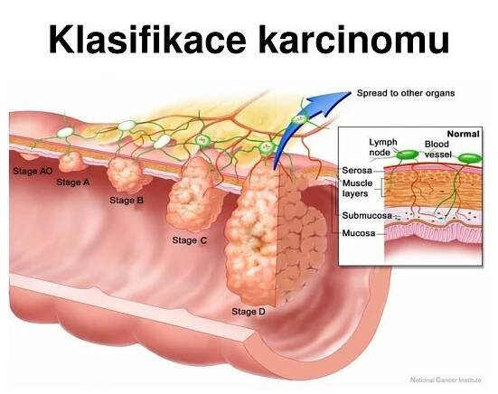 PPT - Kolorektální karcinom PowerPoint Presentation, free download - ID:5290455