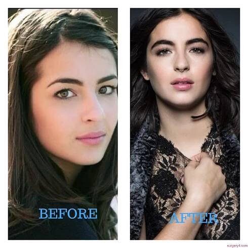 Alanna Masterson Botox Photos [Before & After] - Surgery4