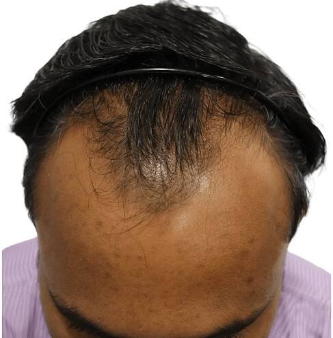 No.1 Hair Transplant Clinic in Ahmedabad | Dr. Aanchal Shah | Zeeva Clinic