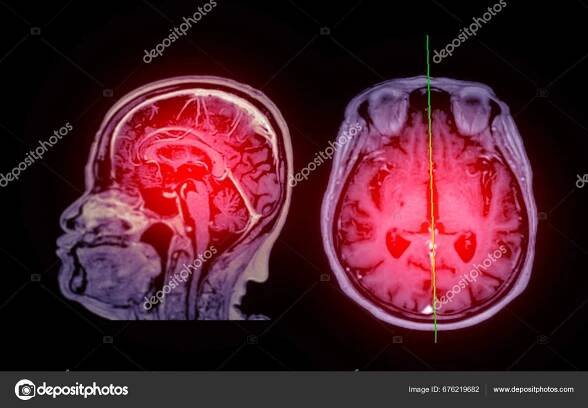 Mri Sken Mozku Axiální Sagitální Pohled Referenční Linií Pro Detekci ...