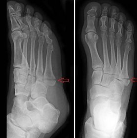 Zlomeniny päty, členkovej kosti, metatarzov a prstov nohy - Medicína a ...