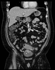 Sigmoid Diverticulitis Complicated by Colovesical Fistula Presenting with Pneumaturia - JETem