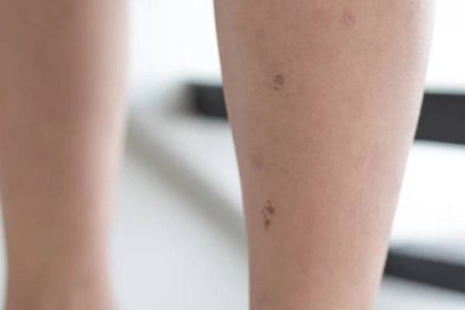 selektivní zaměření na sušené kožní nohy asijského dítěte s lézemi vyrážka jako nemocné z ekzémového onemocnění nebo alergie na kousnutí komáry. koncepce zdravotní péče. - erysipel vyrážka - stock snímky, obrázky a fotky