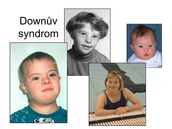 Downův syndrom 