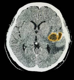 ct vyšetření mozku pacienta s velkými mozkovými abscesy. - absces trauma - stock snímky, obrázky a fotky