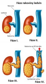 Fáze rakoviny ledvin - ilustrace