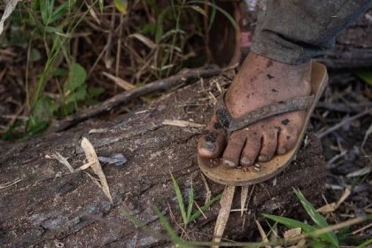 Loggers are frequently injured on the job and largely cannot afford healthcare.