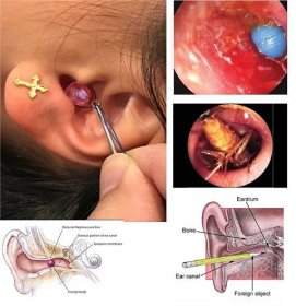 Cizí tělesa v uchu - jak je odstranit? Příznaky cizího tělesa v uchu
