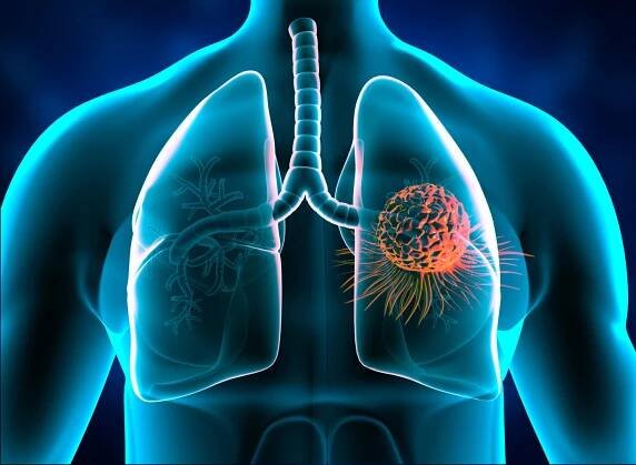 Účinnost brigatinibu u pacientů s metastatickým NSCLC − dat...