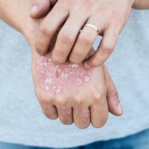 plaque psoriasis