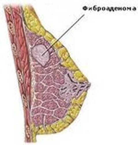 Fibroadenoma / Fibroadenoma