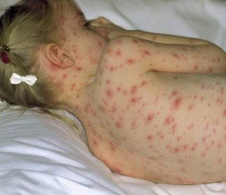 plané neštovice u dětí příznaky foto