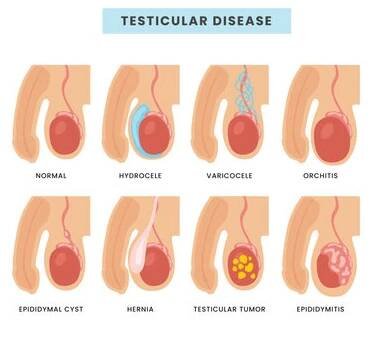 Different types of Testicular diseases types scheme male anatomy medical inflammation, Internal organ penis urologic health varicocele epididymitis orchitis spermatocele testis torsion hidrocele.