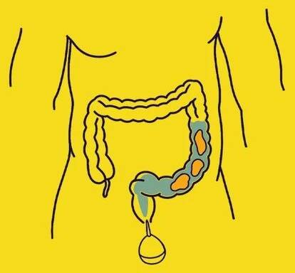 Illustration of intestines and an enema