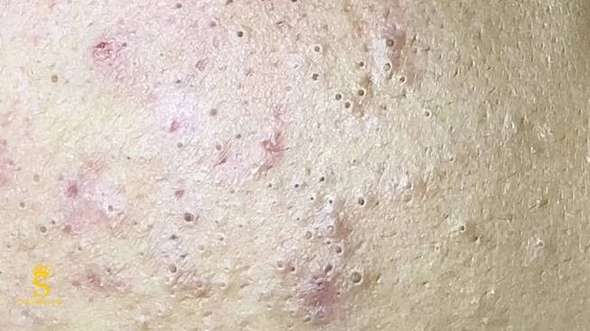 How To Remove A Blackhead