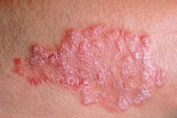 Dermatitida / Dermatitida | Užitečné informace a tipy na péči o sebe. Zdraví, výživa a další.
