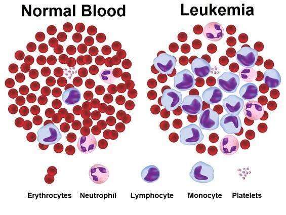 Chronic-Myeloid-Leukemia