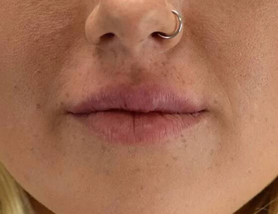 Lip augmentation Before & After Image