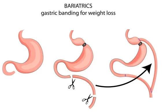 Bariatrics. bandáž s cíle hubnutí — Ilustrace