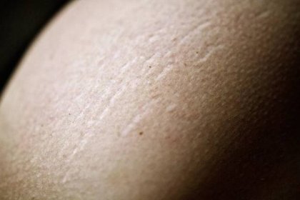 Pimples on Stretch Marks