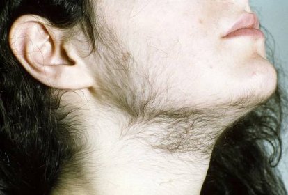 Tmavé chloupky v obličeji ženy jsou nehezké, mohou ale také znamenat vážnou nemoc – Feminela.cz