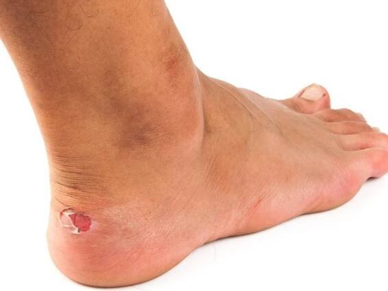 How to Prevent Blisters From Ever Happening Again