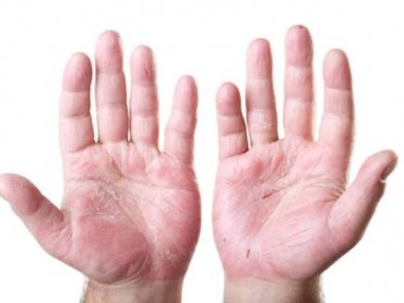 Psoriáza a artritida – jak patří k sobě?