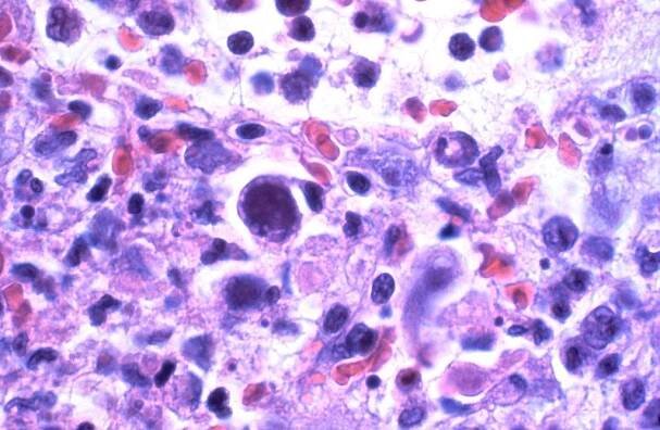 Cytomegalovirus snižuje inteligenci, zjistili vědci