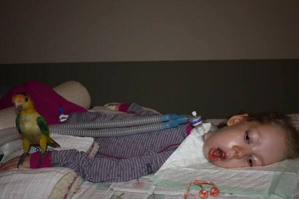 MÍŠNÍ SVALOVÁ ATROFIE TYP 1 - SMA 1, SVALOVÁ ATROFIE